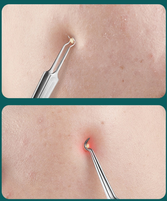Blackhead Clip Tool To Squeeze Acne Acne Needle Acne Clip Tweezers