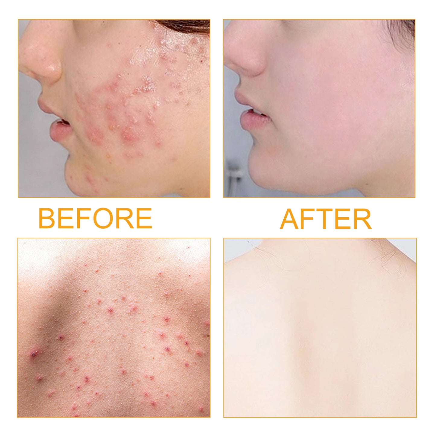 Jayusing Anti-Acne And Anti-Acne Serum, Reduce Acne And Acne Mark Moisturizing Skin Repair Serum