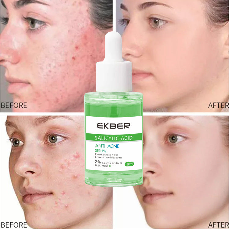Smallpox Diluting Acne Hydrating Repair Acne Removal