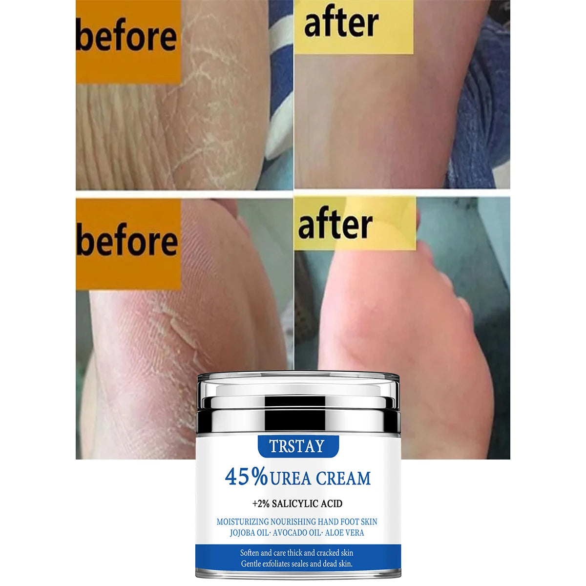 TRSTAY 45% urea cream+2% salicylic acid moisturizes and nourishes hand and foot skin with jojoba oil, avocado oil, and aloe vera