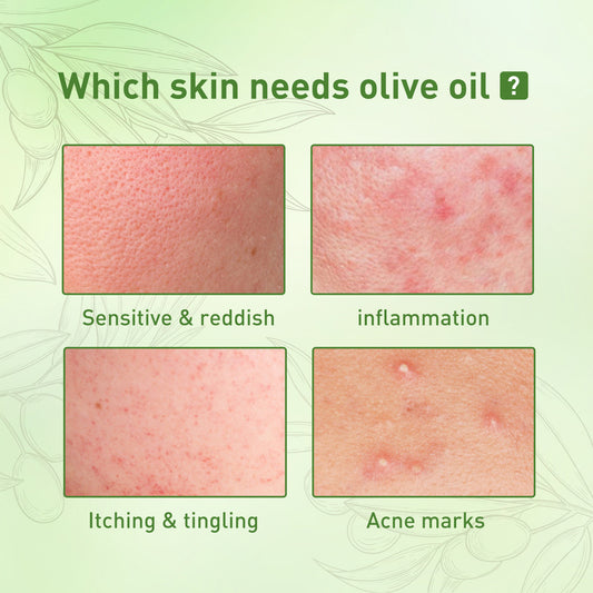 Remove Face Oil Acne Gentle Moisturizing Acne Pit Repair Liquid Fade Face Acne Marks Essential Oil